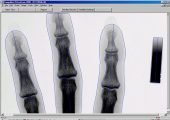 OsteoGram