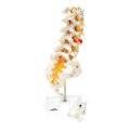 Lumbar Spinal Column with Dorso-lateral Prolapsed Intervertebral Disc