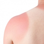 Don’t get burned: Protect your skin during outdoor activities