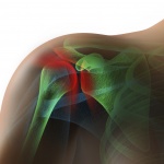 Shoulder impingement and low level laser therapy