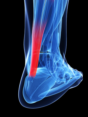 Even in world-class athletes, Achilles tendon injuries can be avoided by looking at the biomechanics of the injury and...