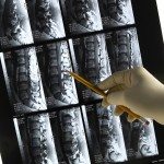 Spinal decompression a promising treatment for slipped disc