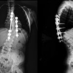 Your role in the detection and treatment for scoliosis