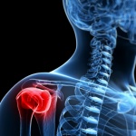 Chiropractic and laser therapy for rotator cuff injuries