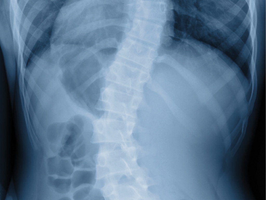 Scoliosis is a three-dimensional manifestation of aberrant spinal biomechanics  — axial (top), sagittal (side) and coronal (front). Surgery and bracing usually address the one-coronal dimension.