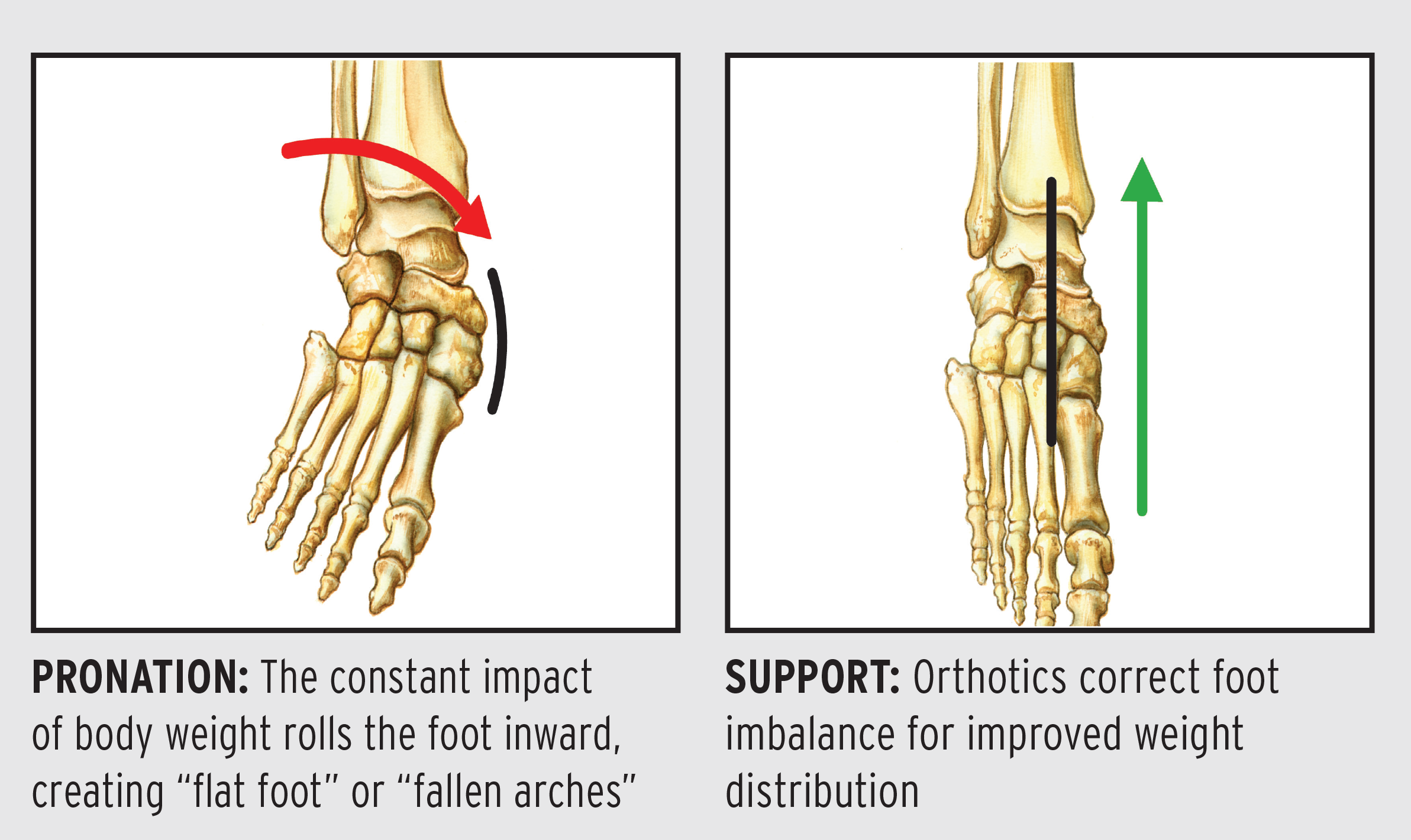 Asymmetrical excessive pronation and effect on chiropractic