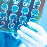 Concussion treatment protocols: chiropractic case studies
