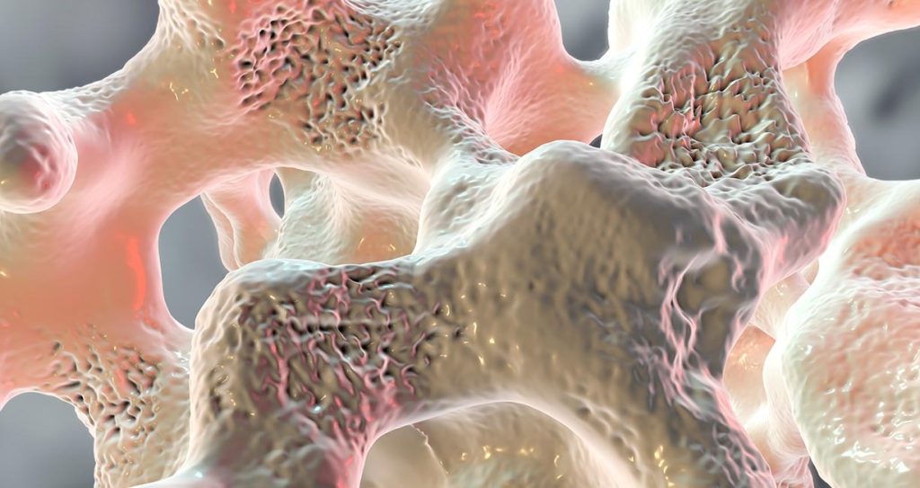 Early warning signs of osteoporosis and determining cause before treatment; testing for the 10+ contributors