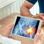 The importance of X-rays before and after hip replacement