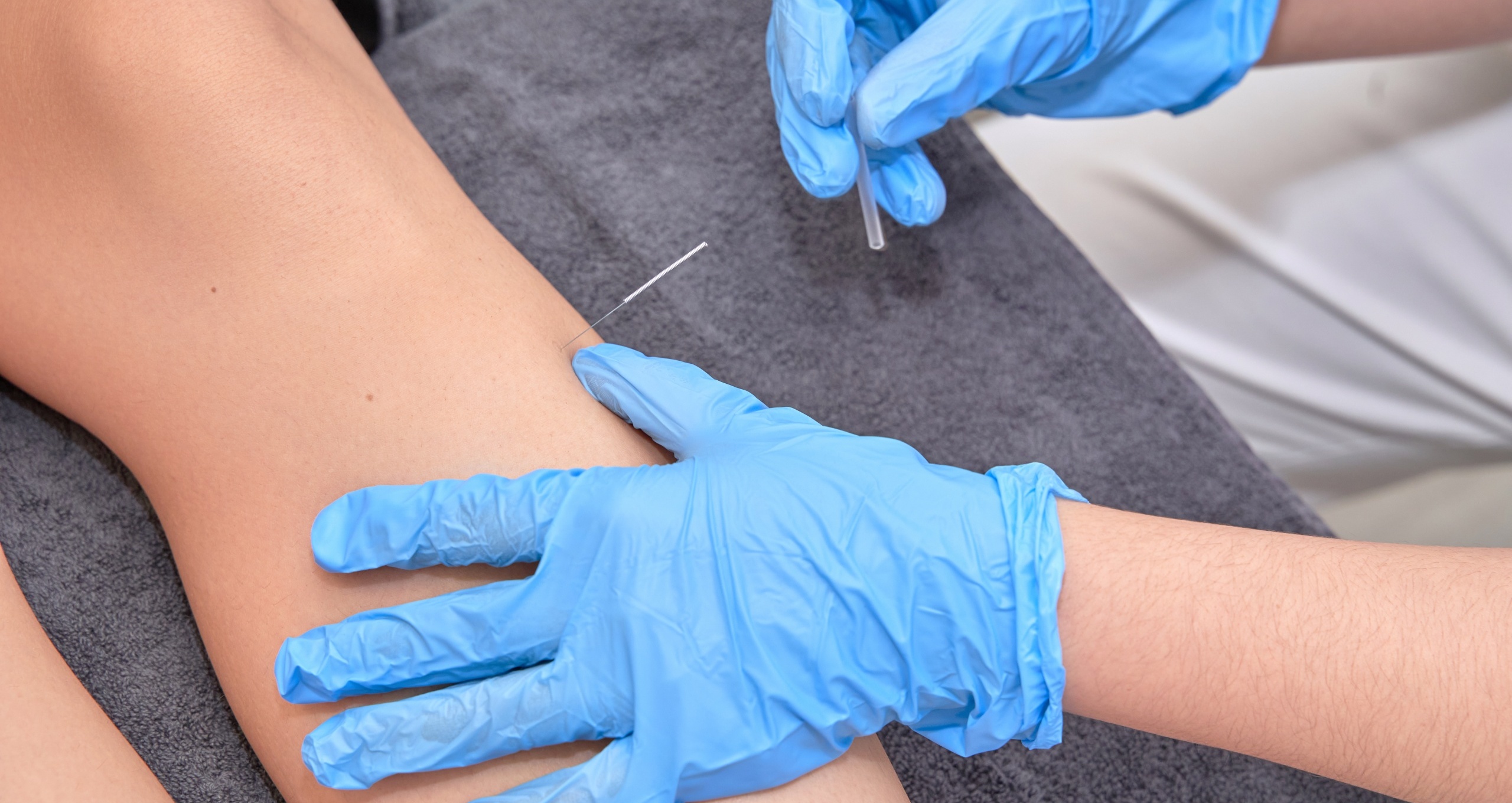dry needling