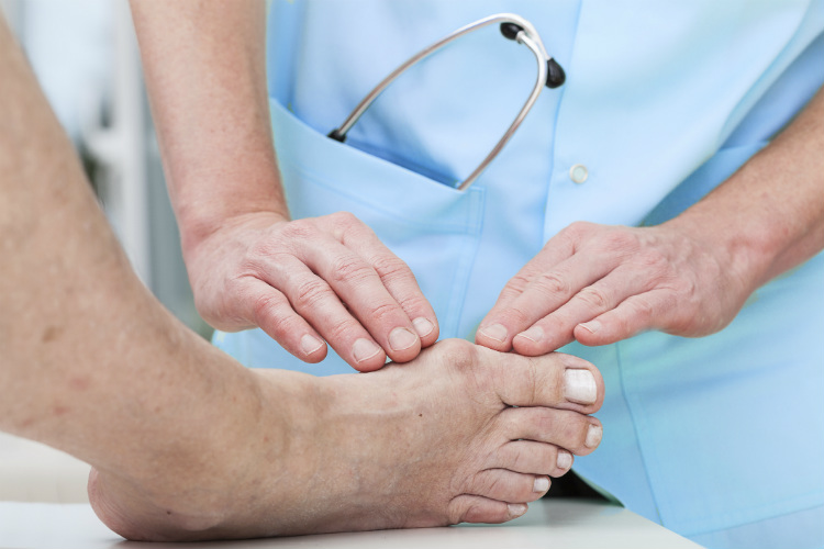 bunions